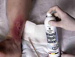 Wound Wash Saline