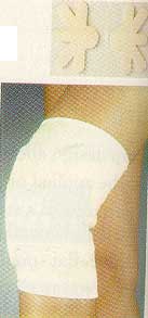 The Schultz Knee Stabilizer