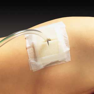 Lyofoam T Dressing