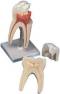 3 Part Upper Triple-Root Molar Model
