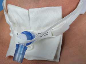 Tracheostomy Vent Tie, Anti-Disconnect