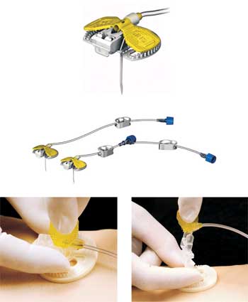 0191010SIHSMD-Huber LiftLoc Safety Wing Infusion Set 19 Gauge x 1 in. Long 8 in. Tubing